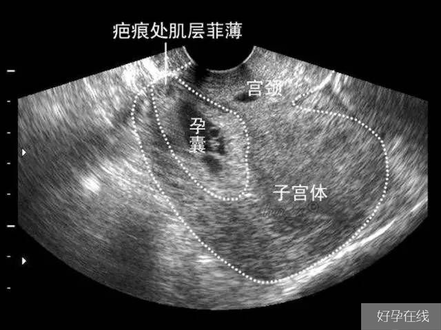 疤痕妊娠需严格产检