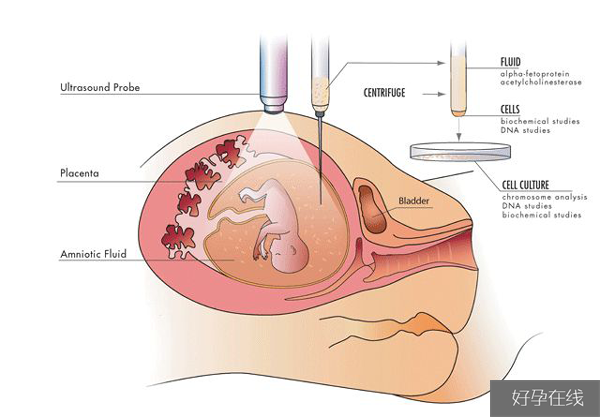 羊水穿刺检查示意图