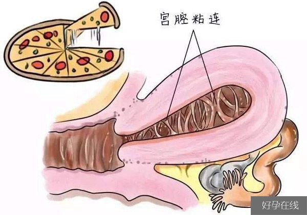 宫腔粘连可以做试管婴儿吗