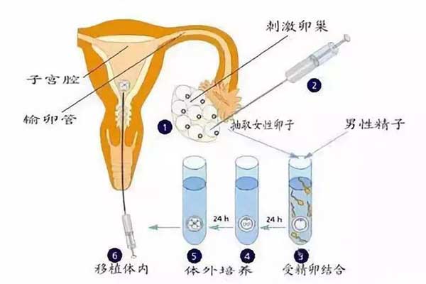 试管婴儿取卵手术流程