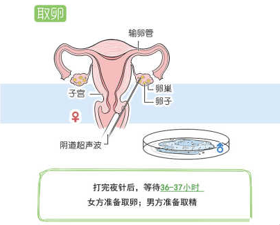 女方取卵，男方取精