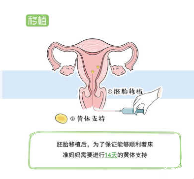 在培养液中形成受精卵之后进行胚胎移植