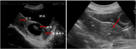 切口妊娠超声表现图片