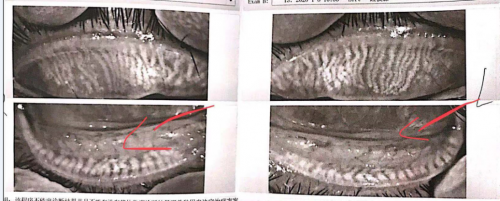 眼睛疲劳，眼睛干燥，眼睛干痒，爱尔眼科光润干眼治疗高效省时