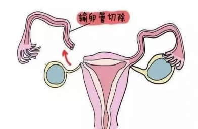 重庆慈铭博鳌国际医院三代试管婴儿，切除双侧输卵管还能做试管婴儿吗？