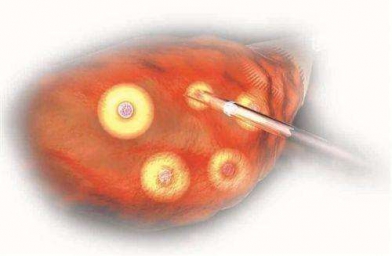 重庆格鲁吉亚Innova医院专家解释促排卵有几种方式？